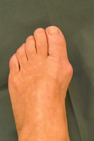 Hallux valgus